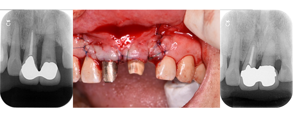 歯科医院で行われている再生療法：歯周組織再生療法、歯髄再生療法 