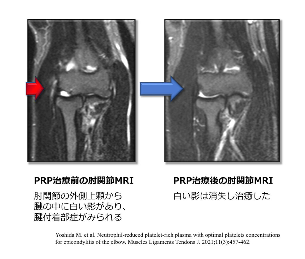 PRP治療前後の膝関節MRI①
