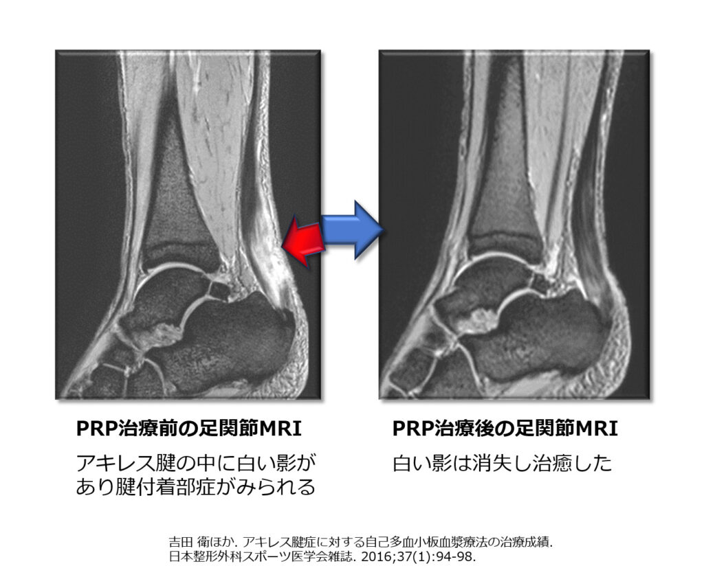 PRP治療前後の膝関節MRI②