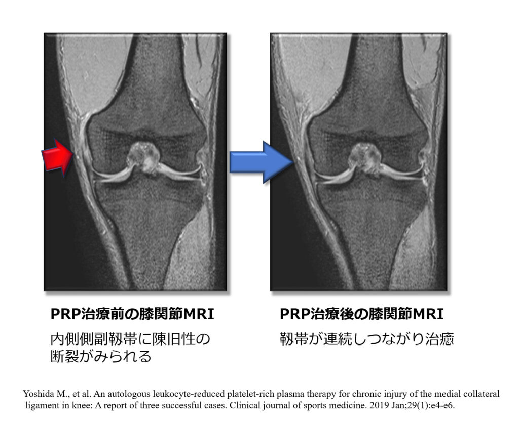 PRP治療前後の膝関節MRI③