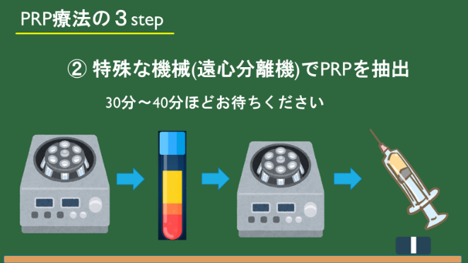 PRP療法の3ステップ：特殊な機械（遠心分離機）でPRPを抽出