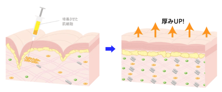 血漿線維芽細胞療法とは何ですか?